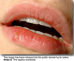 Herpes Simplex also known as Cold Sore